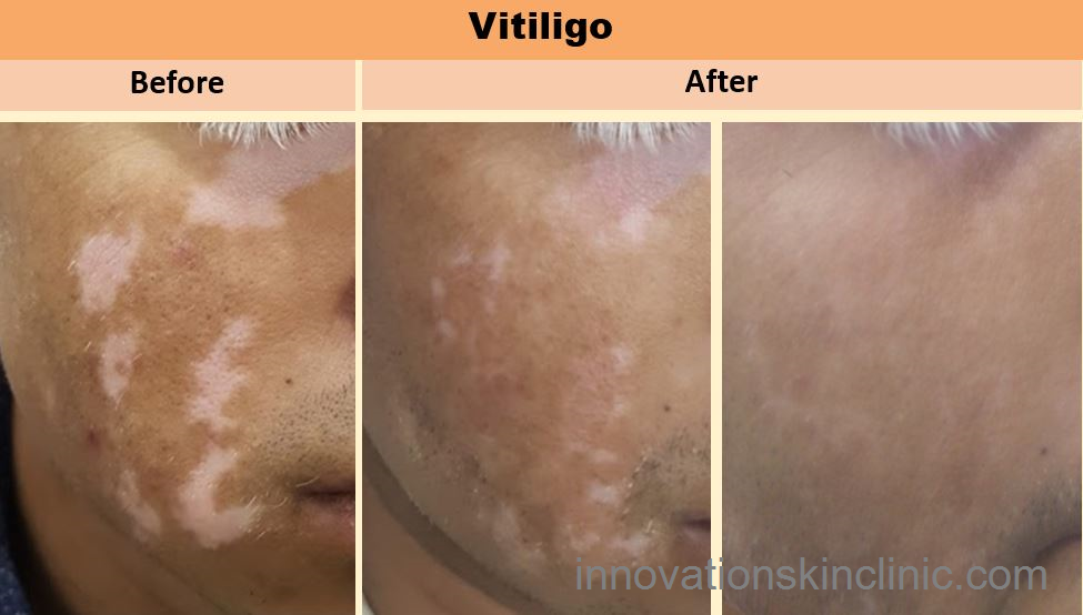 Vitiligo surgery 3